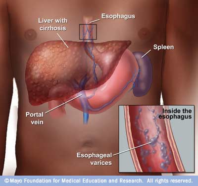 esophageal bleeding cirrhosis