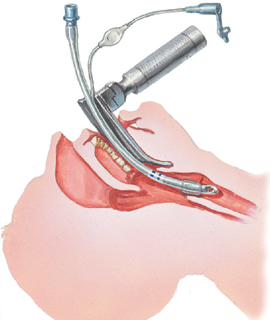 Respiratory tube on sale