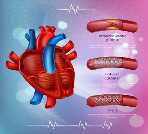 WHAT IS A HEART STENT AND WHY WOULD YOUR MOM NEED IT?