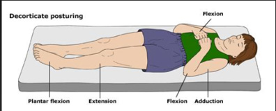 Abnormal flexion response to pain