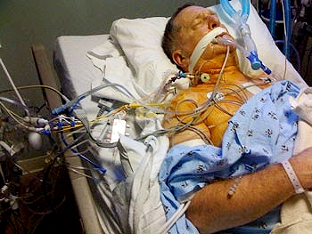My Brother is in ICU Ventilated. Why Are They Covering the Worst-Case Scenario for my Brother?