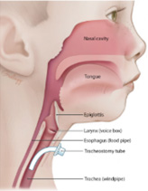 WHAT IS A TRACHEOSTOMY?